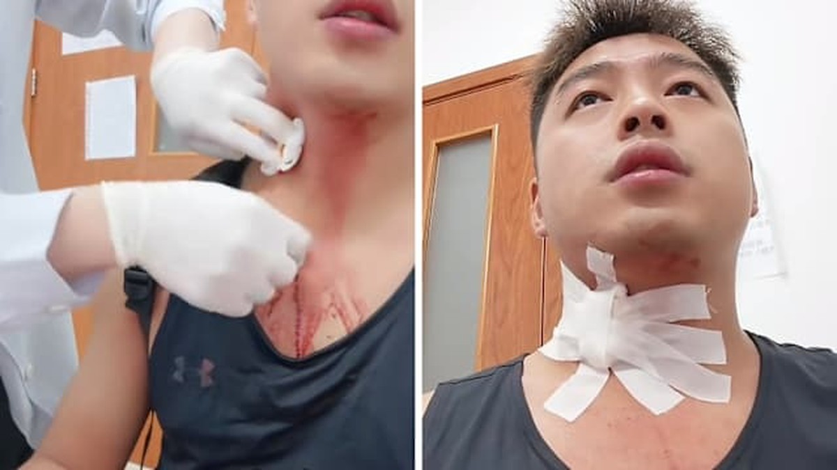 Nguy cơ chảy máu nghiêm trọng do đập muỗi: Câu chuyện bất ngờ từ một người đàn ông