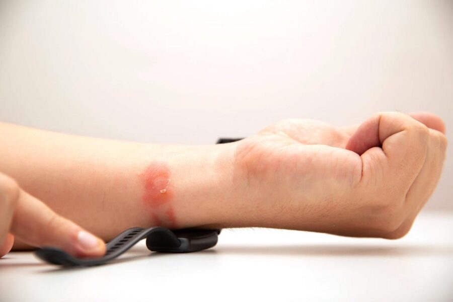 Dị Ứng Khi Đeo Đồng Hồ Thể Thao: Đâu Là Nguyên Nhân Thực Sự?